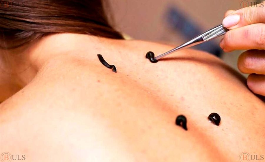 гирудотерапевт